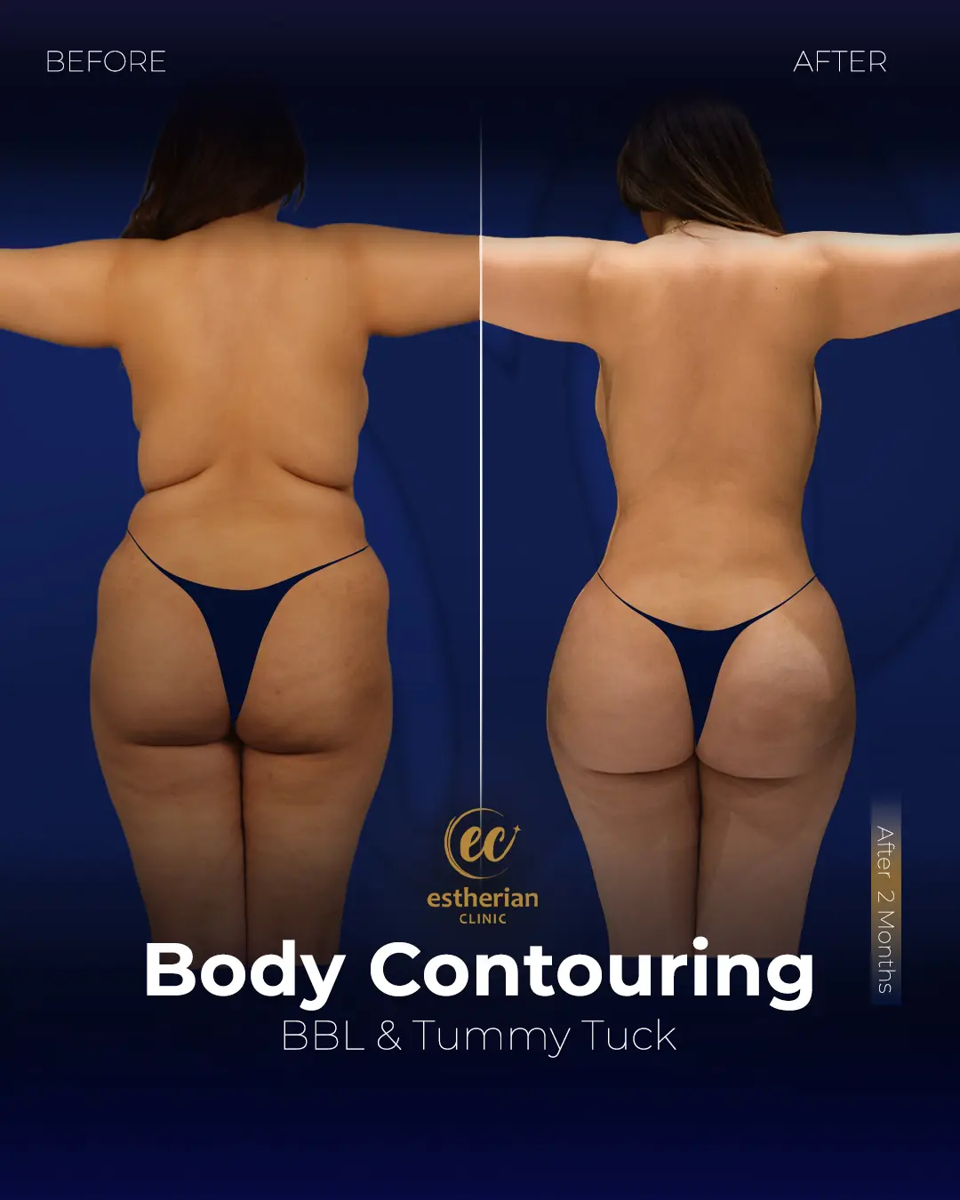 Body Contouring Surgery (before and after) by the Estherian Clinic