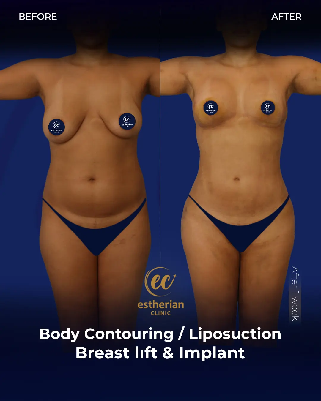 Body Contouring Surgery (before and after) by the Estherian Clinic