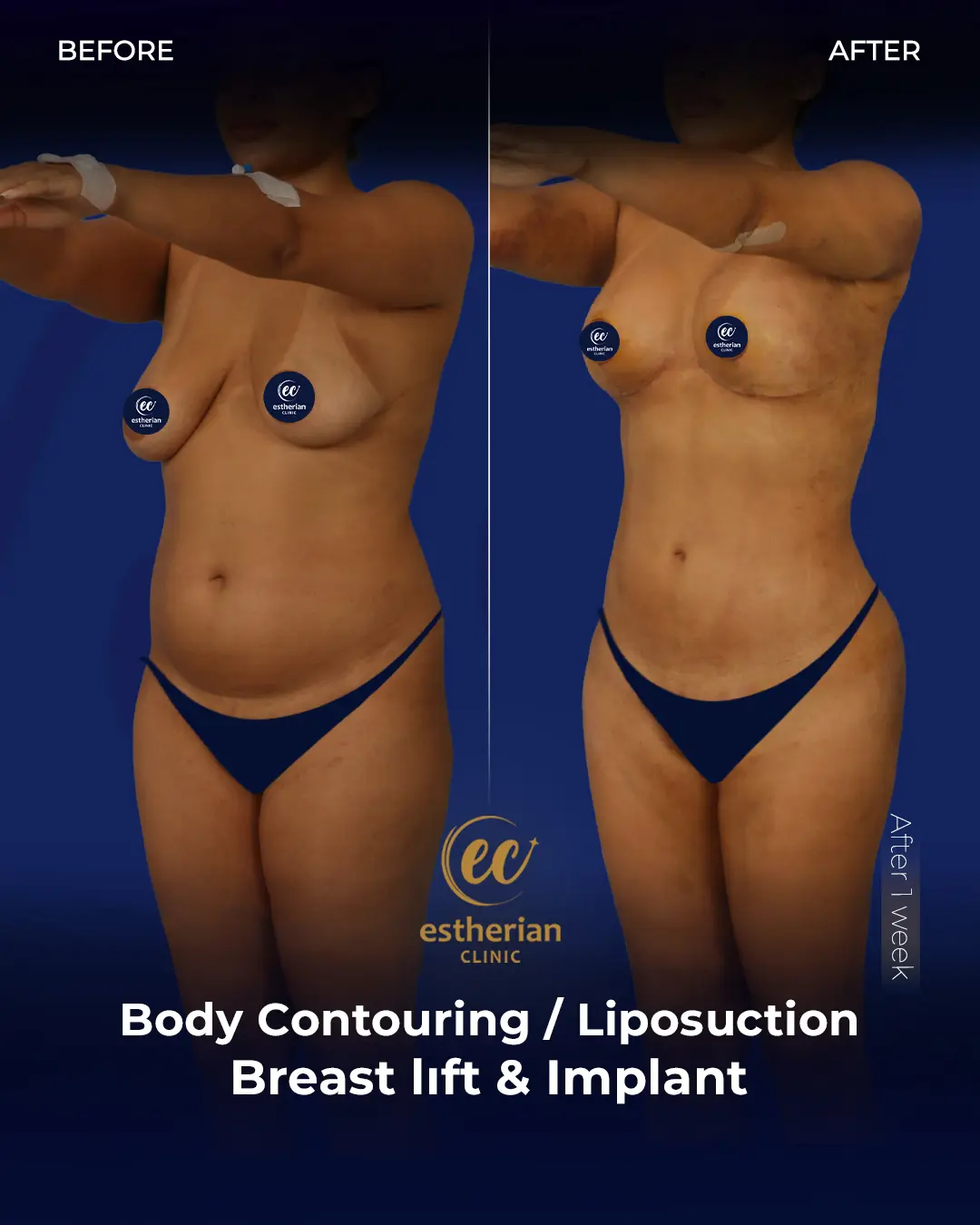 Body Contouring Surgery (before and after) by the Estherian Clinic