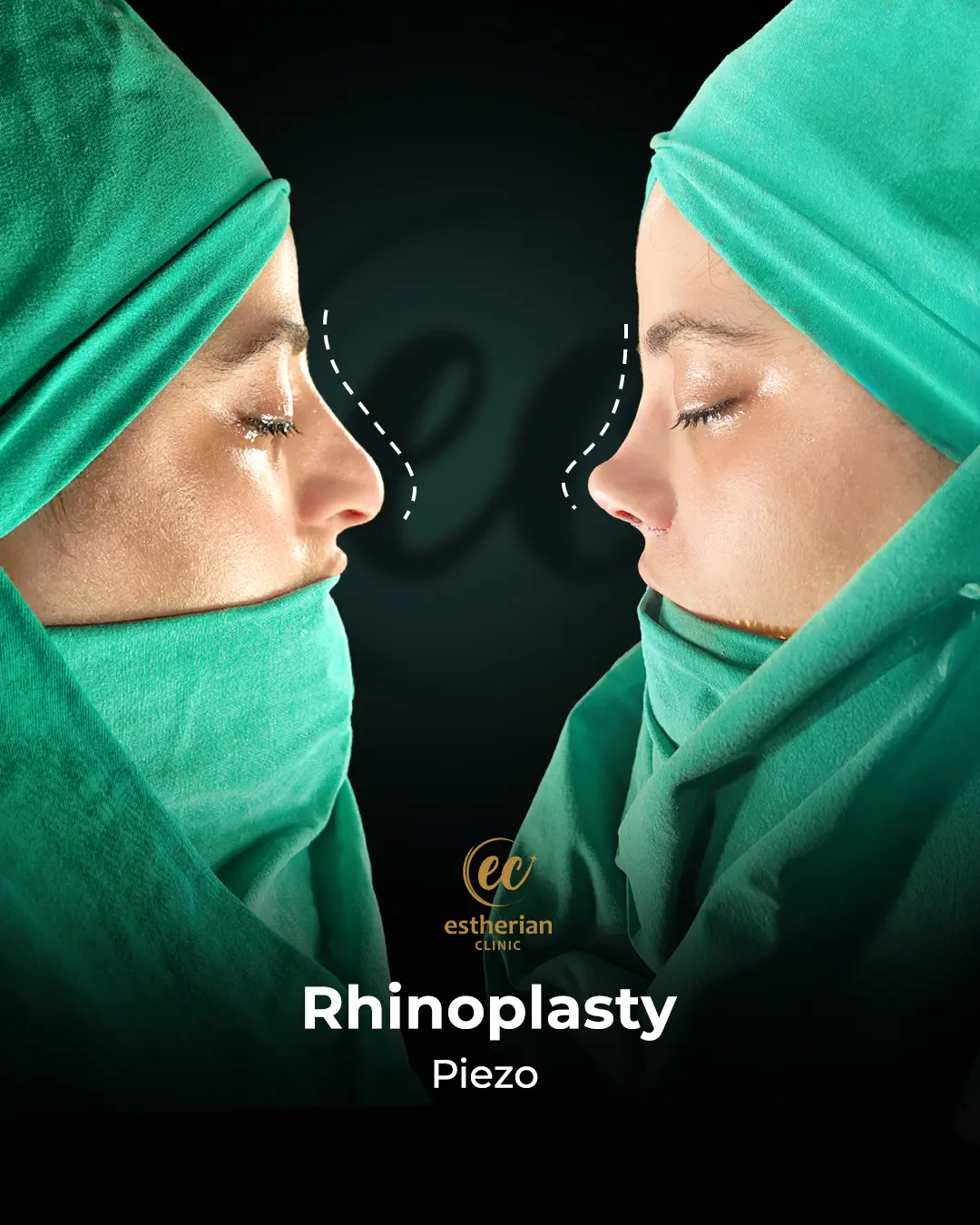 Rhinoplasty Before and After by the Estherian Clinic