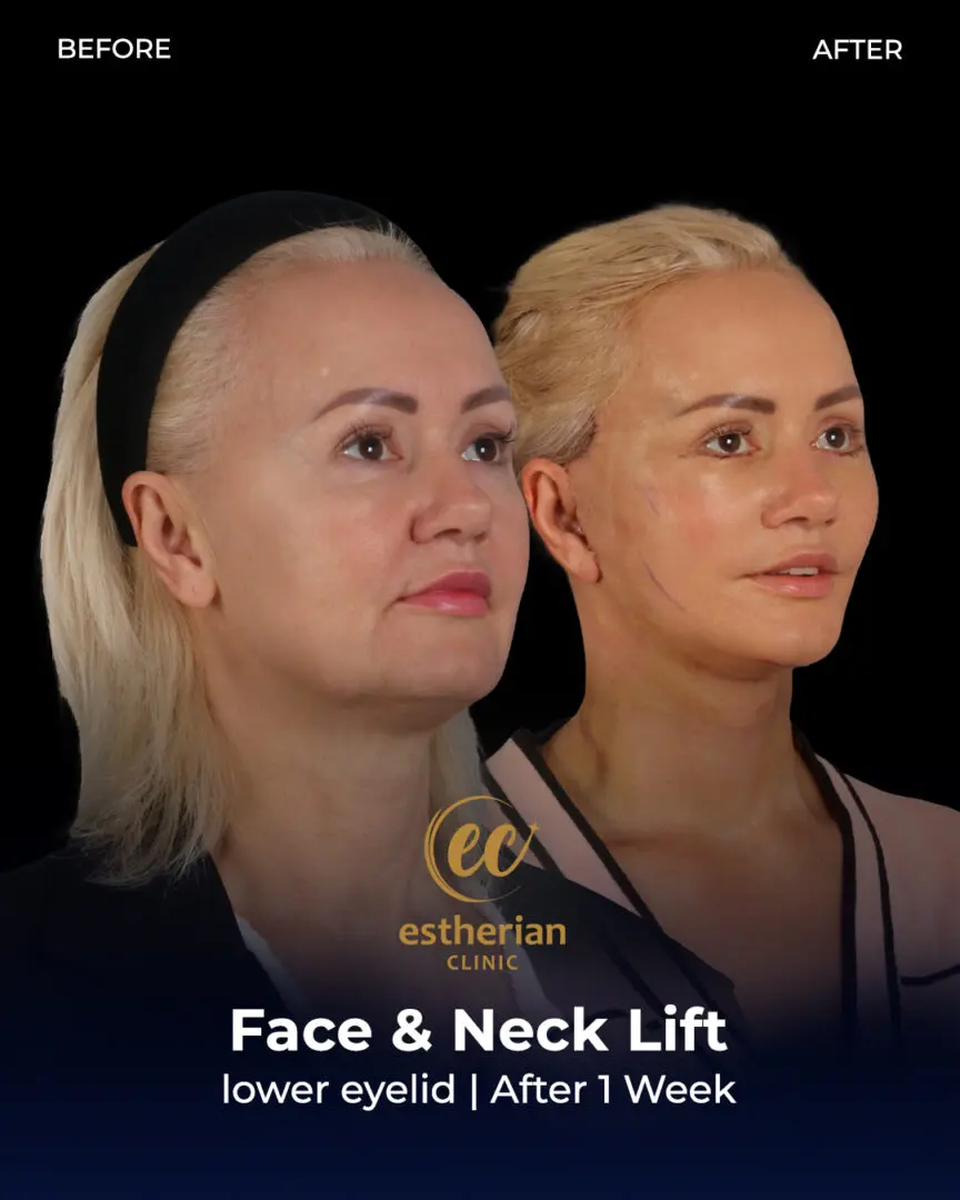 Face and Neck Lift Before and After Gallery by the Estherian Clinic