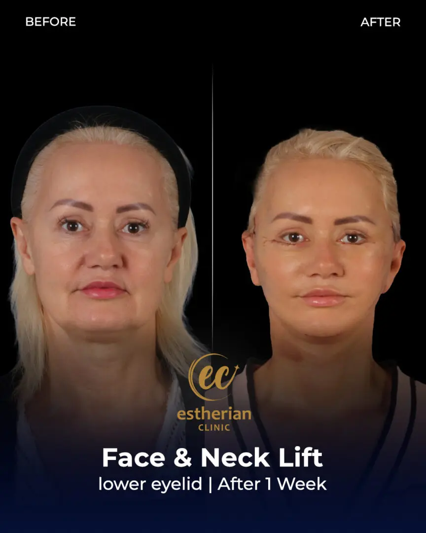 Face and Neck Lift Before and After Gallery by the Estherian Clinic