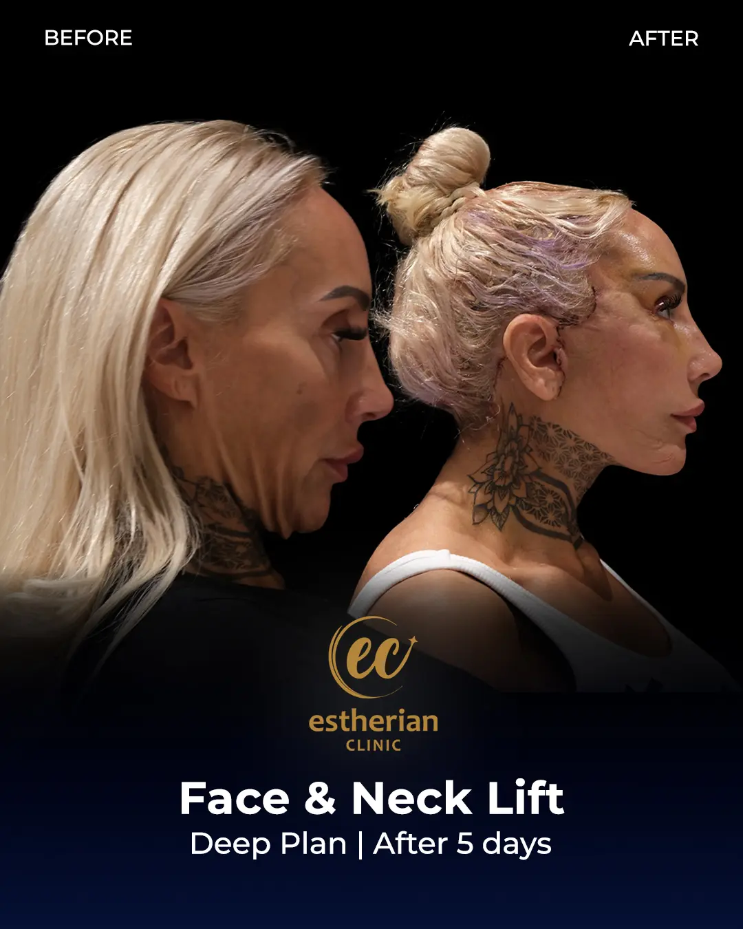 Face and Neck Lift Before and After Gallery by the Estherian Clinic