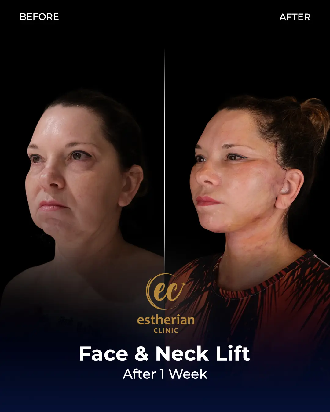 Face and Neck Lift Before and After Gallery by the Estherian Clinic
