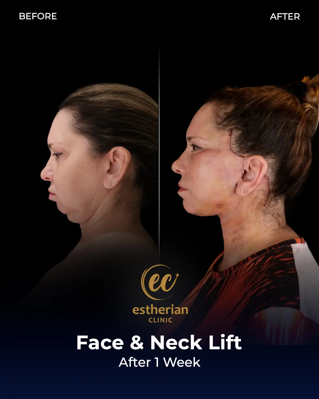 Face and Neck Lift Before and After Gallery by the Estherian Clinic