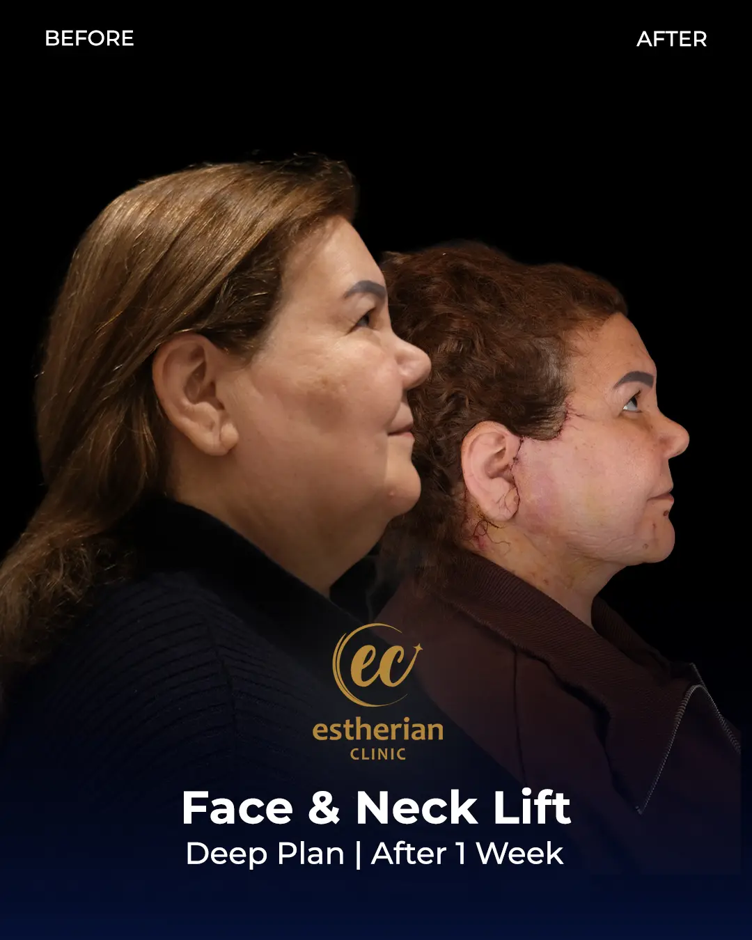 Face and Neck Lift Before and After Gallery by the Estherian Clinic