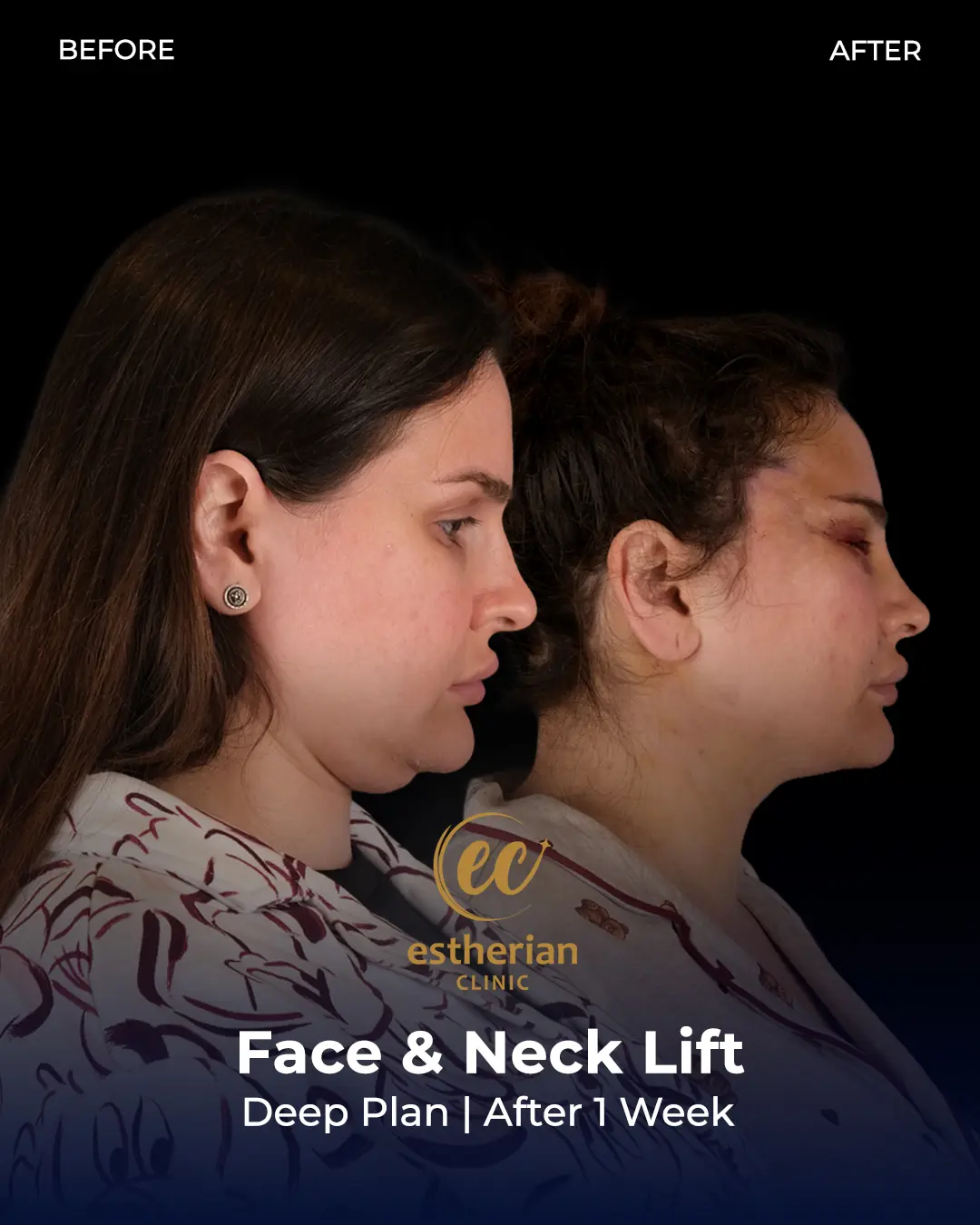 Face and Neck Lift Before and After Gallery by the Estherian Clinic