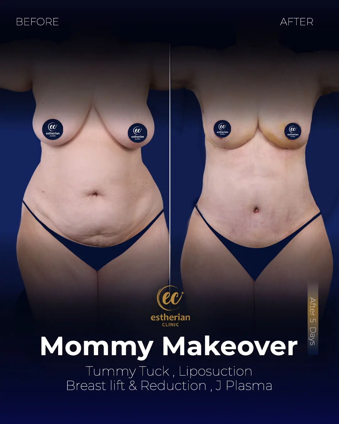 Body Contouring Surgery (before and after) by the Estherian Clinic
