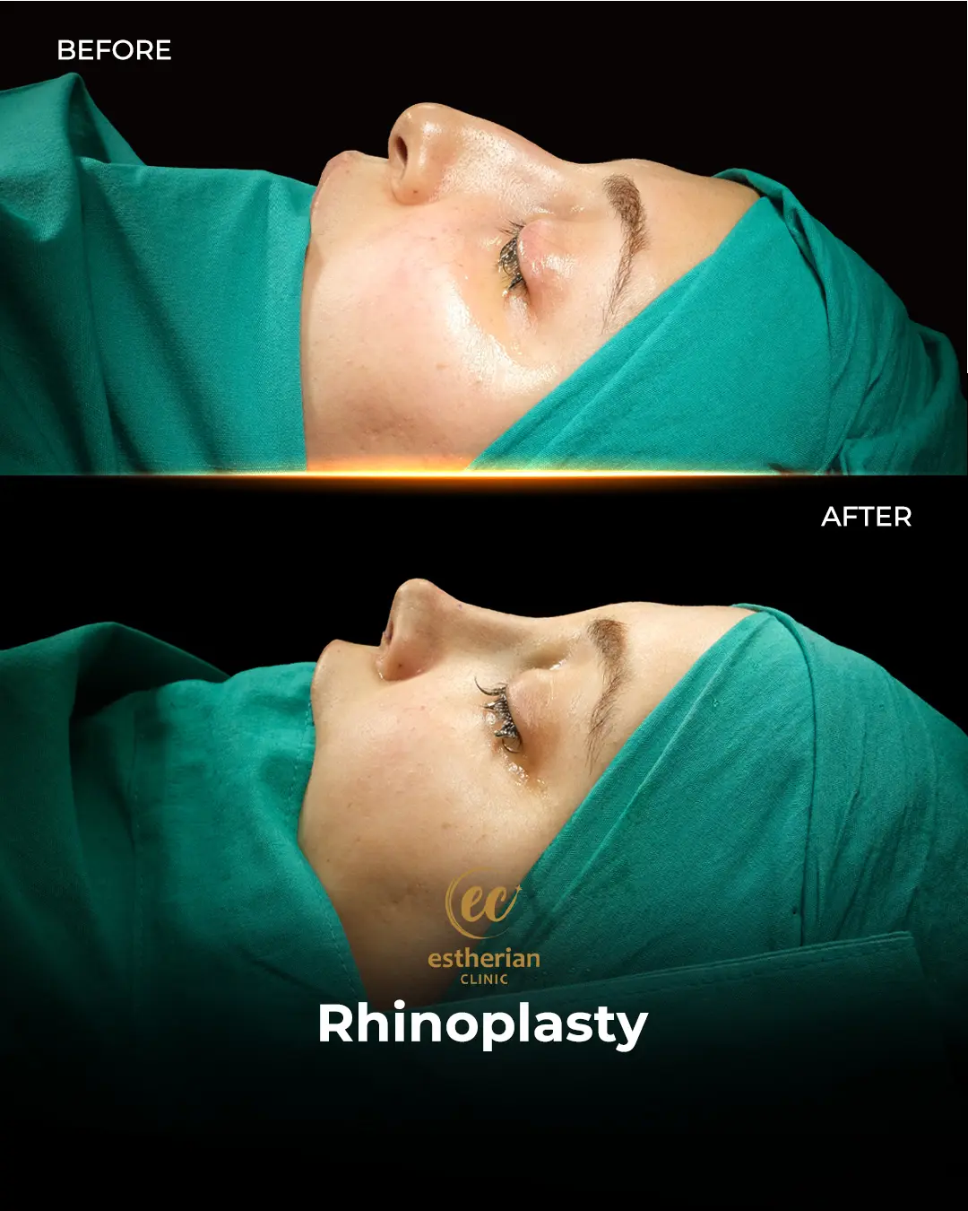 Rhinoplasty Before and After by the Estherian Clinic