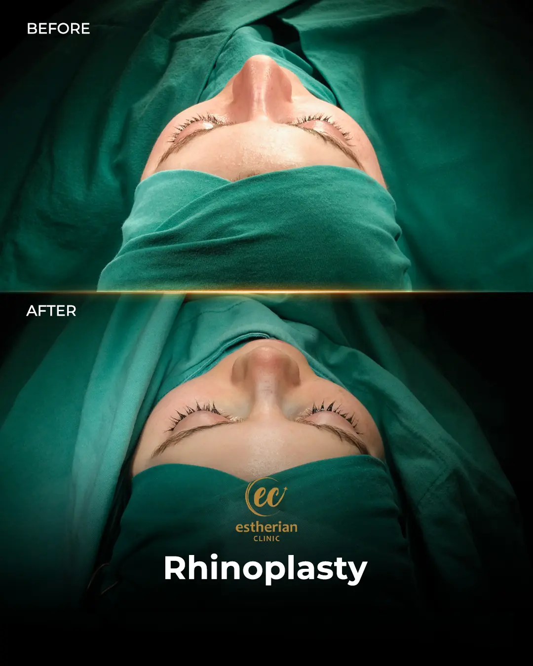 Rhinoplasty Before and After by the Estherian Clinic