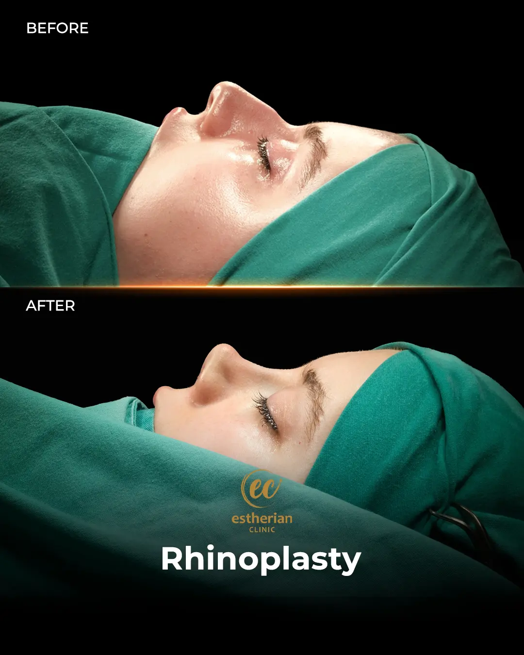 Rhinoplasty Before and After by the Estherian Clinic