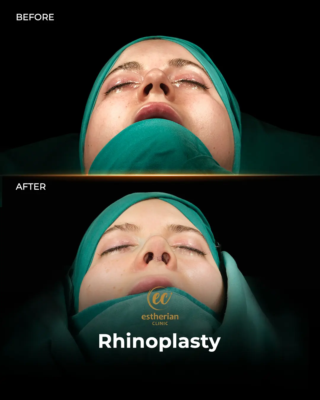Rhinoplasty Before and After by the Estherian Clinic