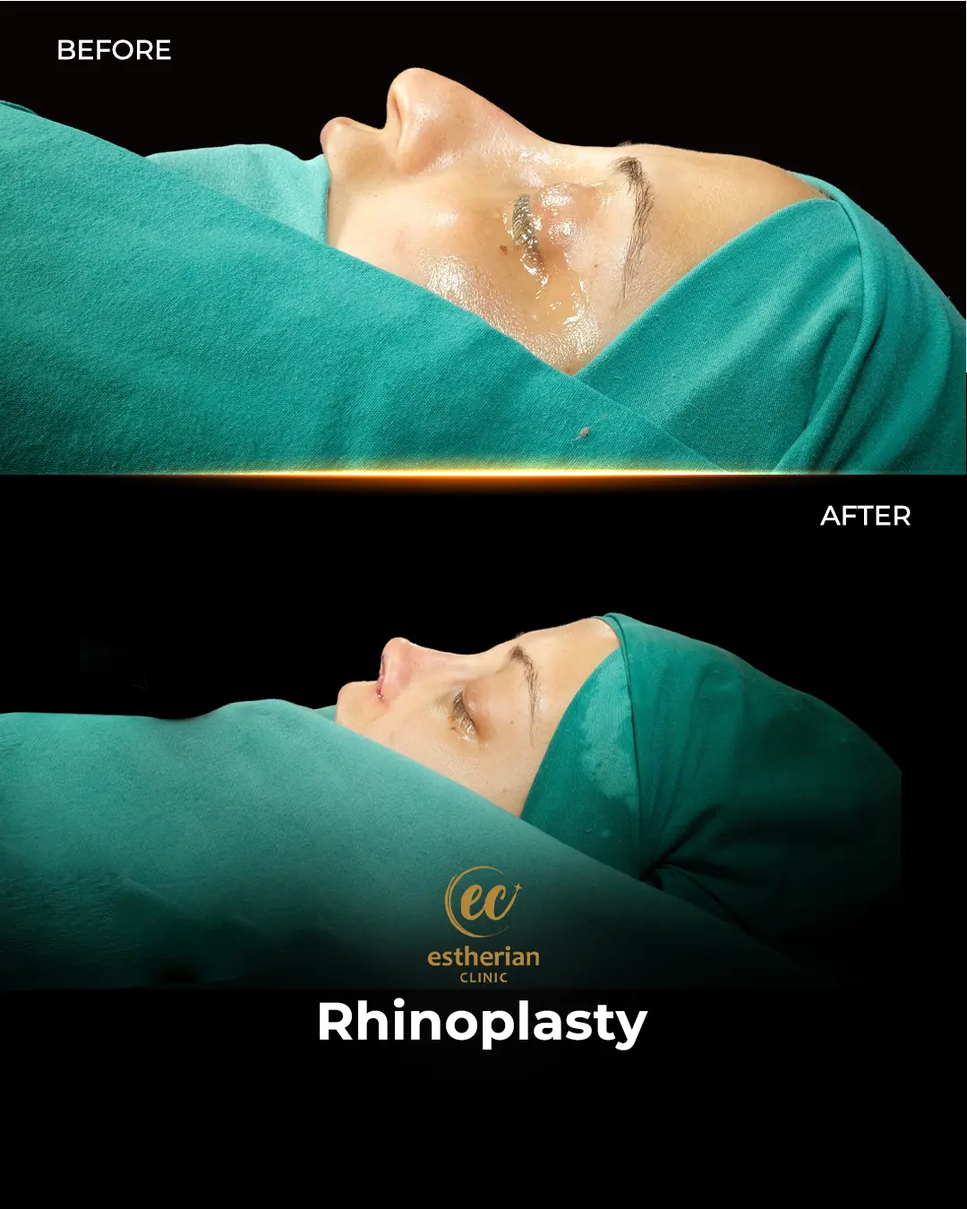 Rhinoplasty Before and After by the Estherian Clinic