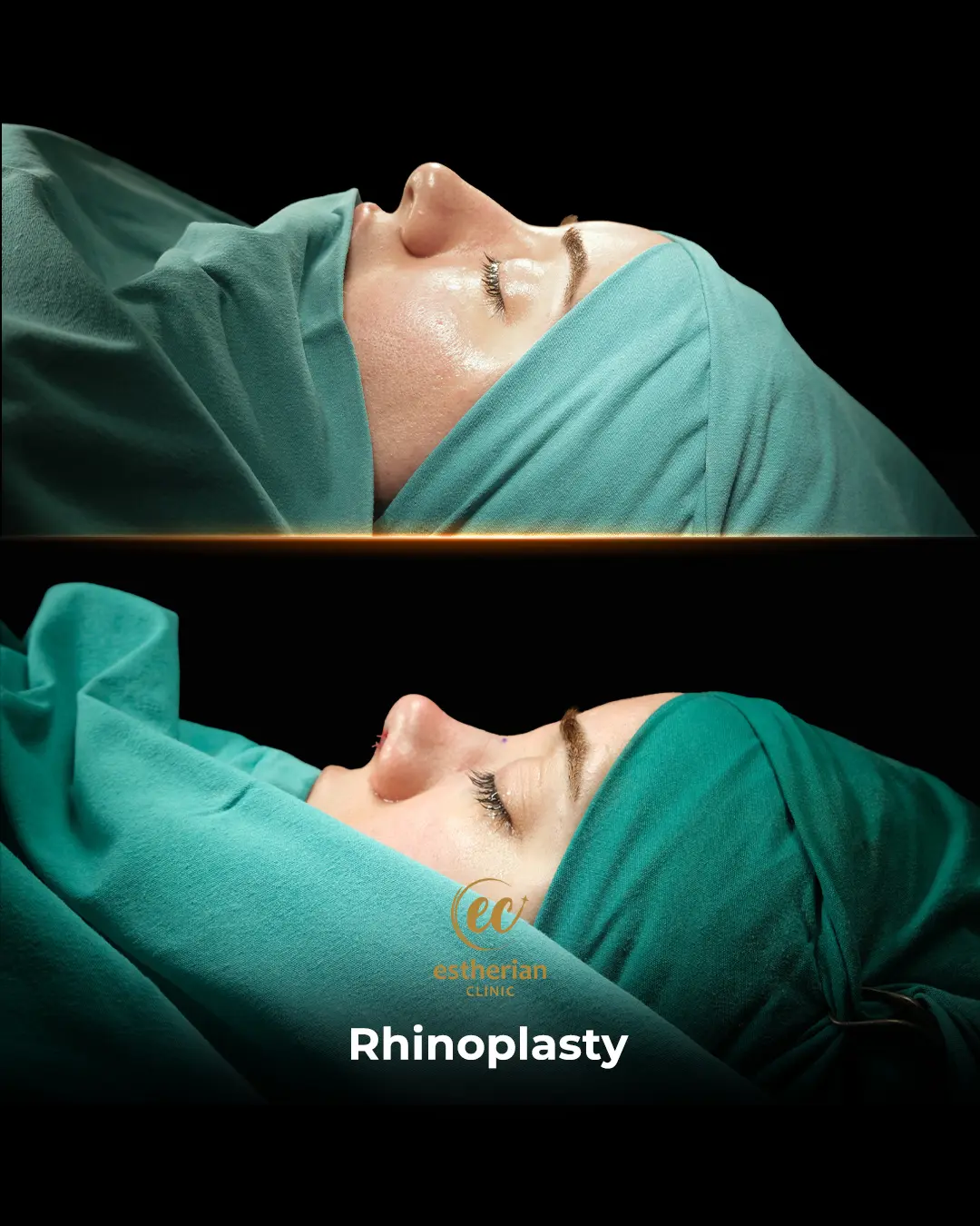 Rhinoplasty Before and After by the Estherian Clinic
