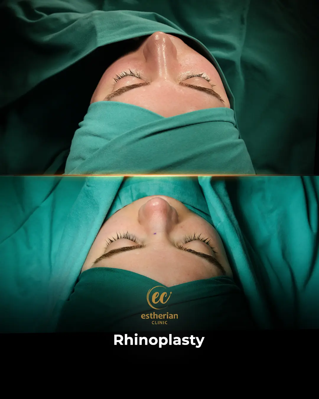 Rhinoplasty Before and After by the Estherian Clinic