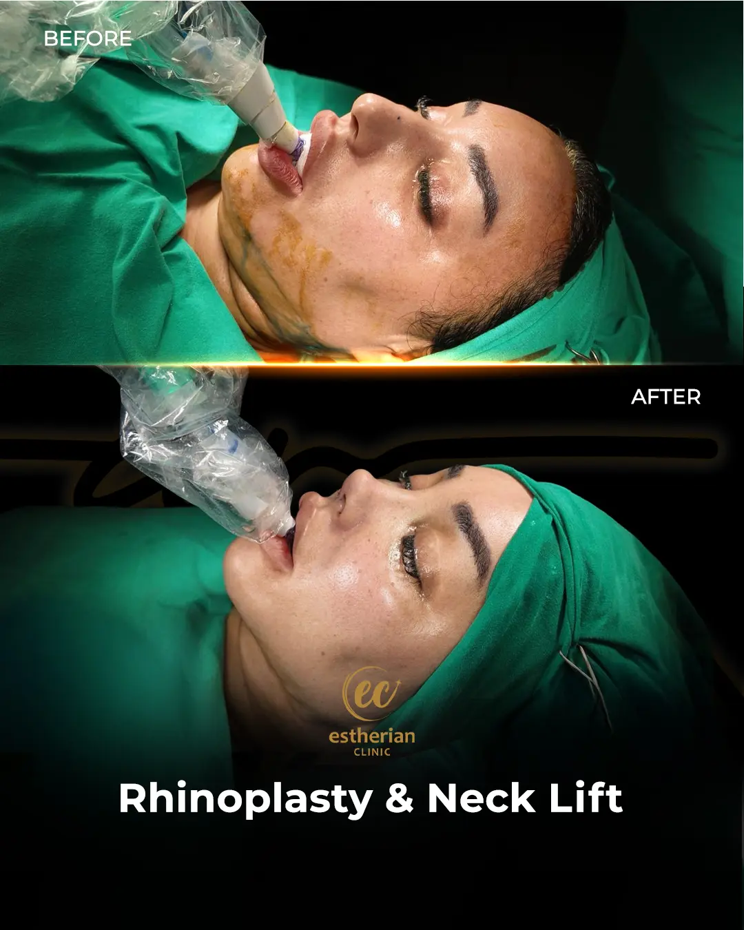 Rhinoplasty Before and After by the Estherian Clinic