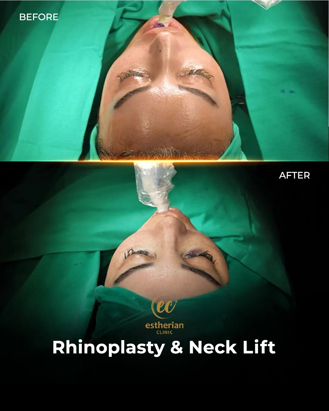 Rhinoplasty Before and After by the Estherian Clinic