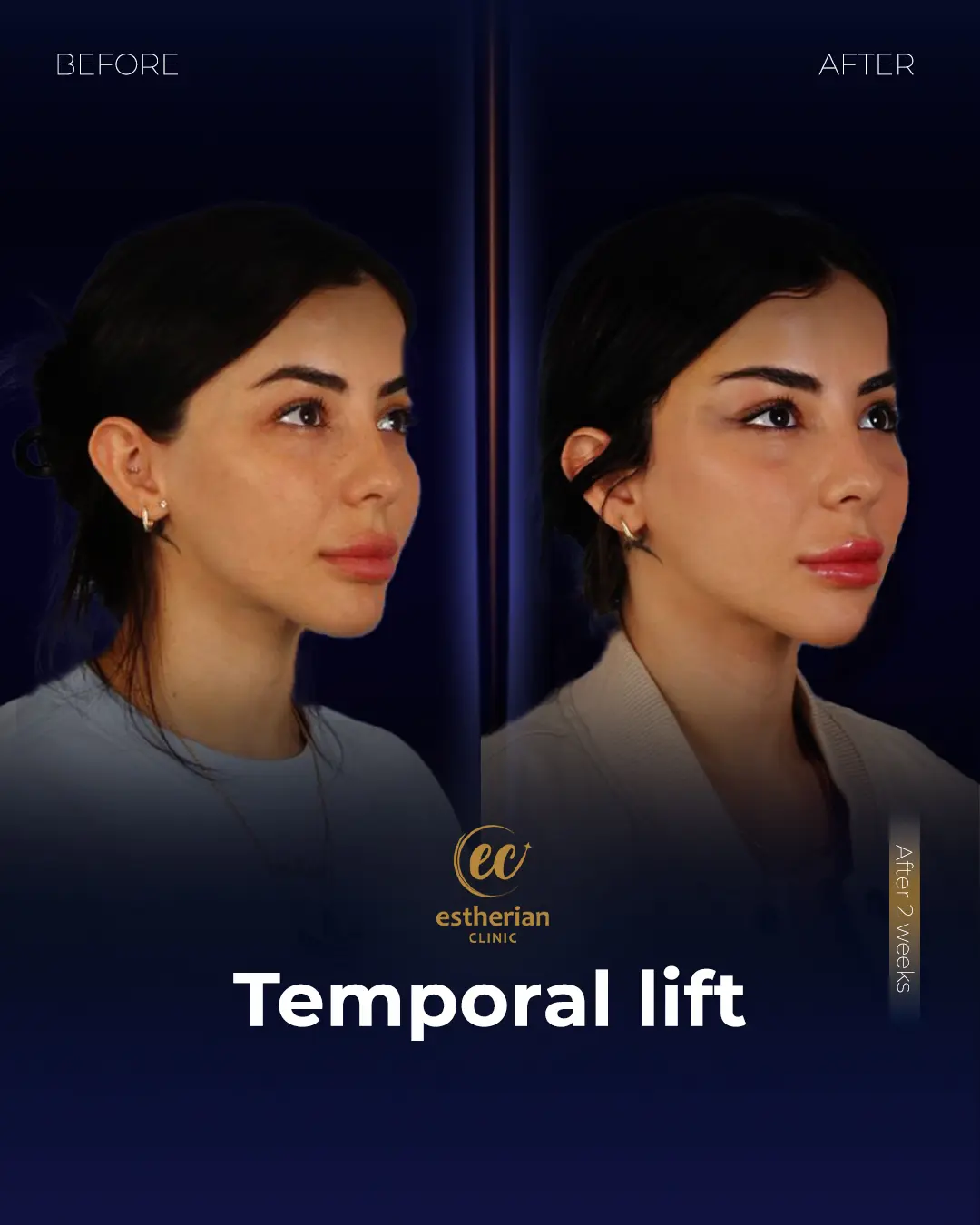 Temporal Lift by the Estherian Clinic