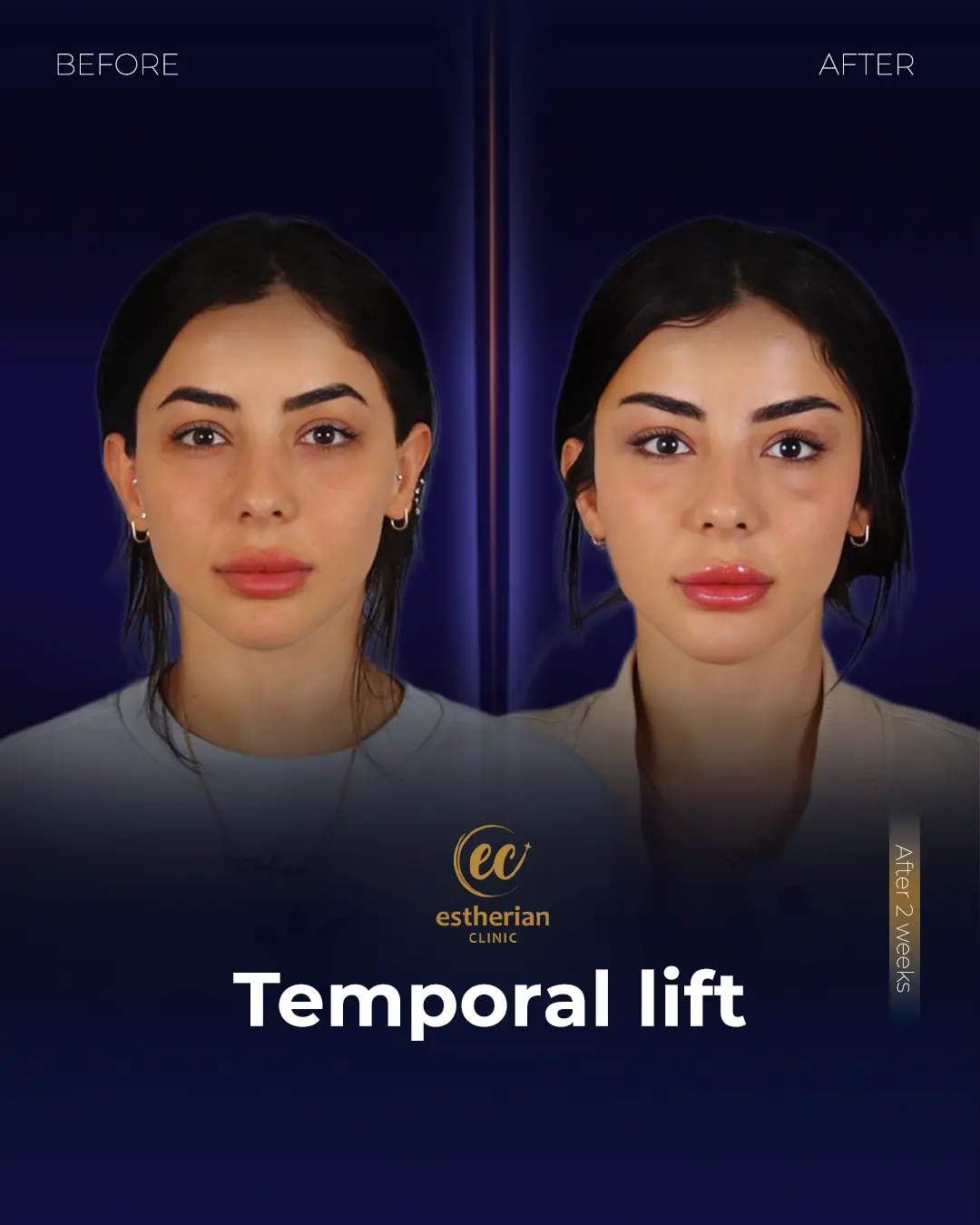 Temporal Lift by the Estherian Clinic