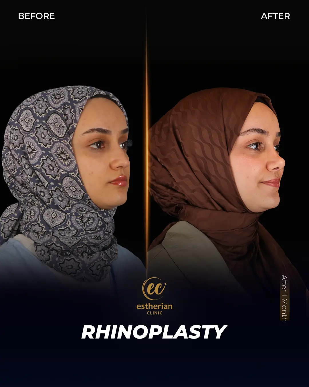 Rhinoplasty Before and After by the Estherian Clinic