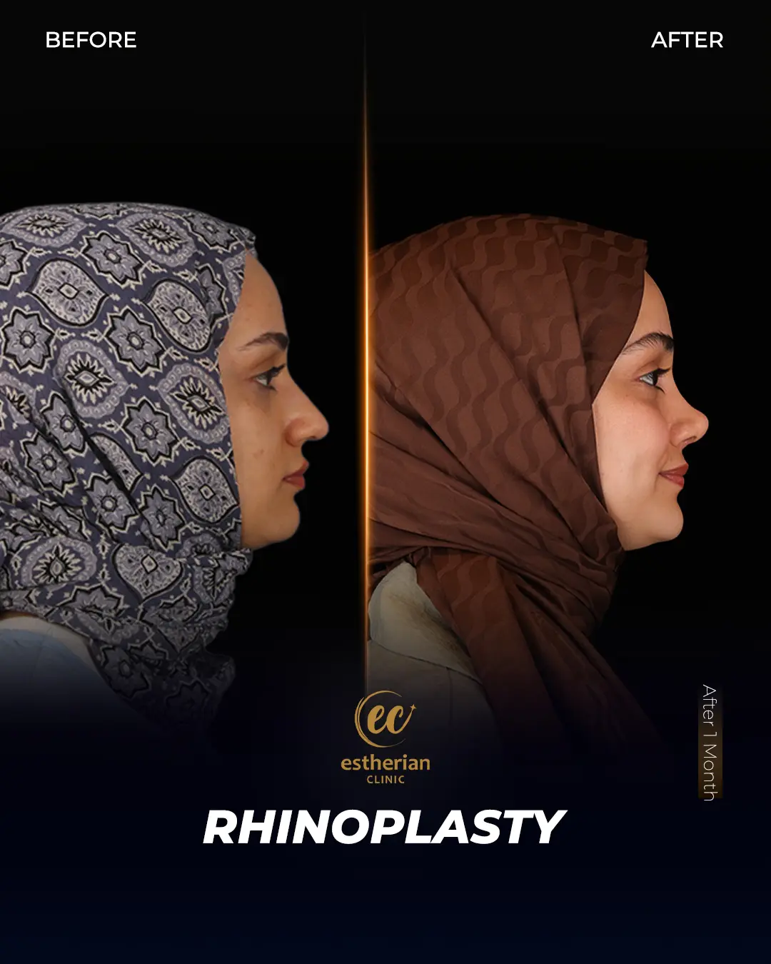 Rhinoplasty Before and After by the Estherian Clinic