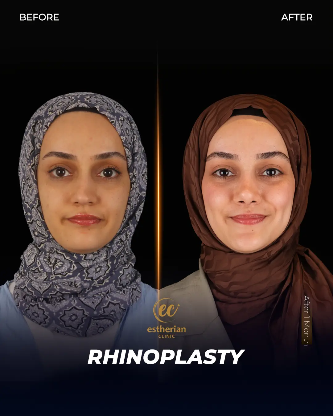 Rhinoplasty Before and After by the Estherian Clinic