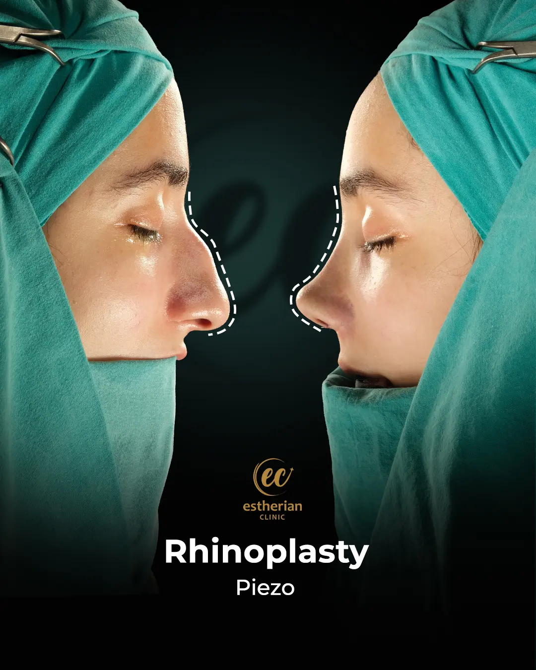 Rhinoplasty Before and After by the Estherian Clinic