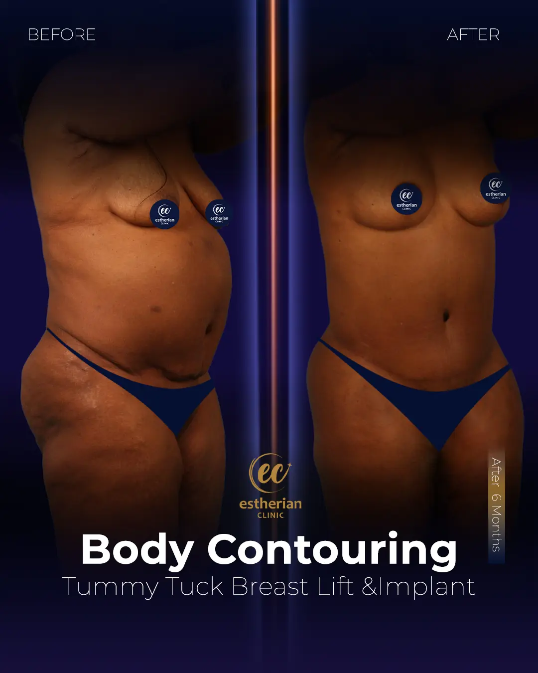 Body Contouring Surgery (before and after) by the Estherian Clinic