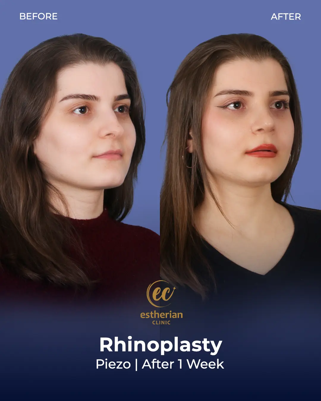 Rhinoplasty Before and After by the Estherian Clinic