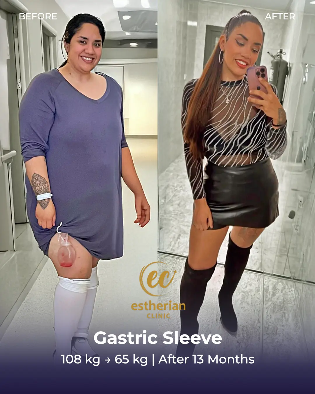Gastric Sleeve Surgery (Bariatric Surgery) Before-and-after Real Patient Transformation by the Estherian Clinic