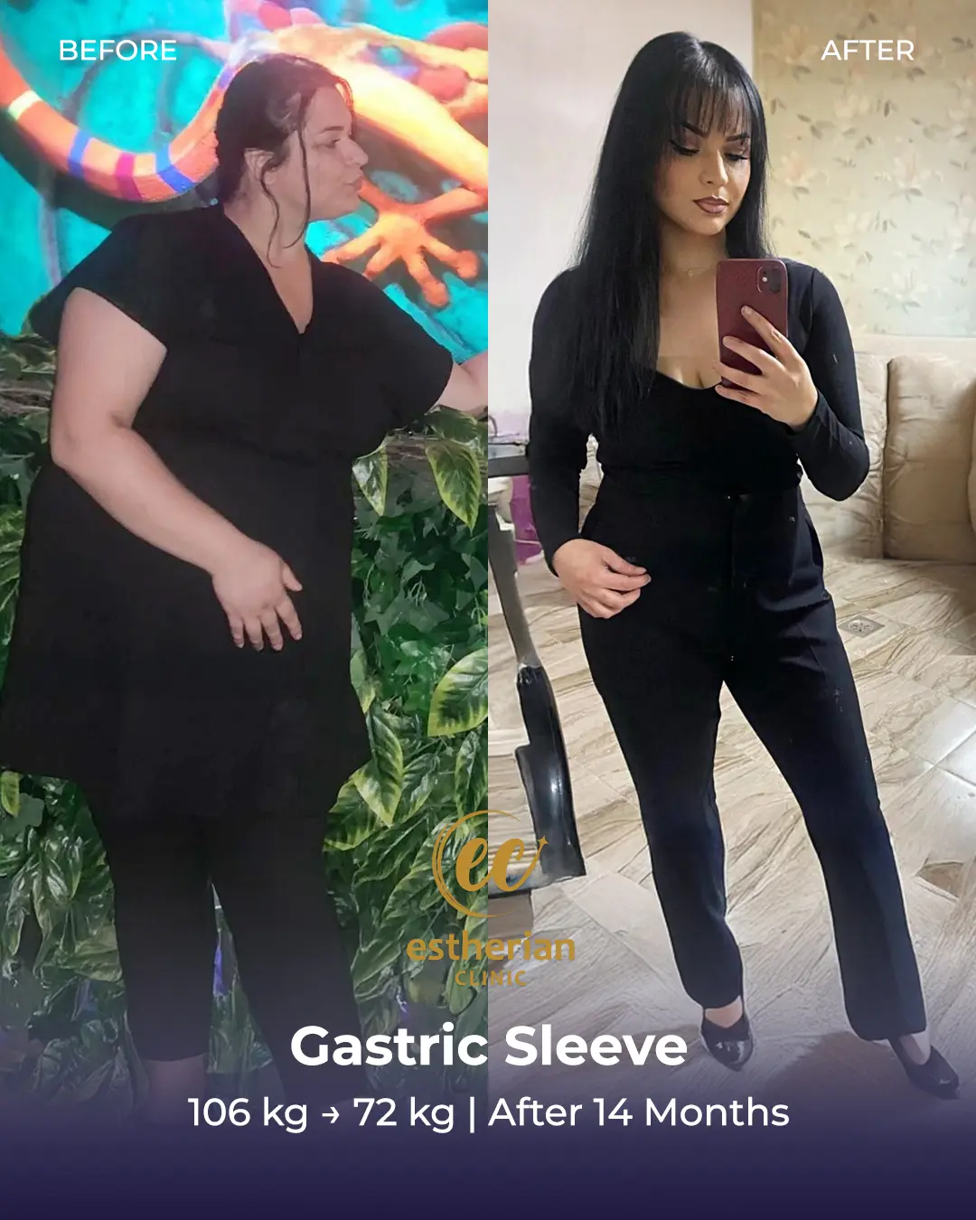 Gastric Sleeve Surgery (Bariatric Surgery) Before-and-after Real Patient Transformation by the Estherian Clinic