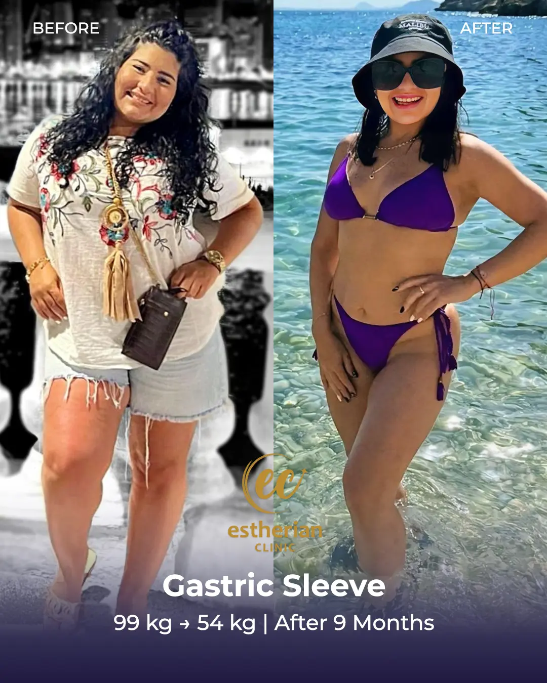 Gastric Sleeve Surgery (Bariatric Surgery) Before-and-after Real Patient Transformation by the Estherian Clinic