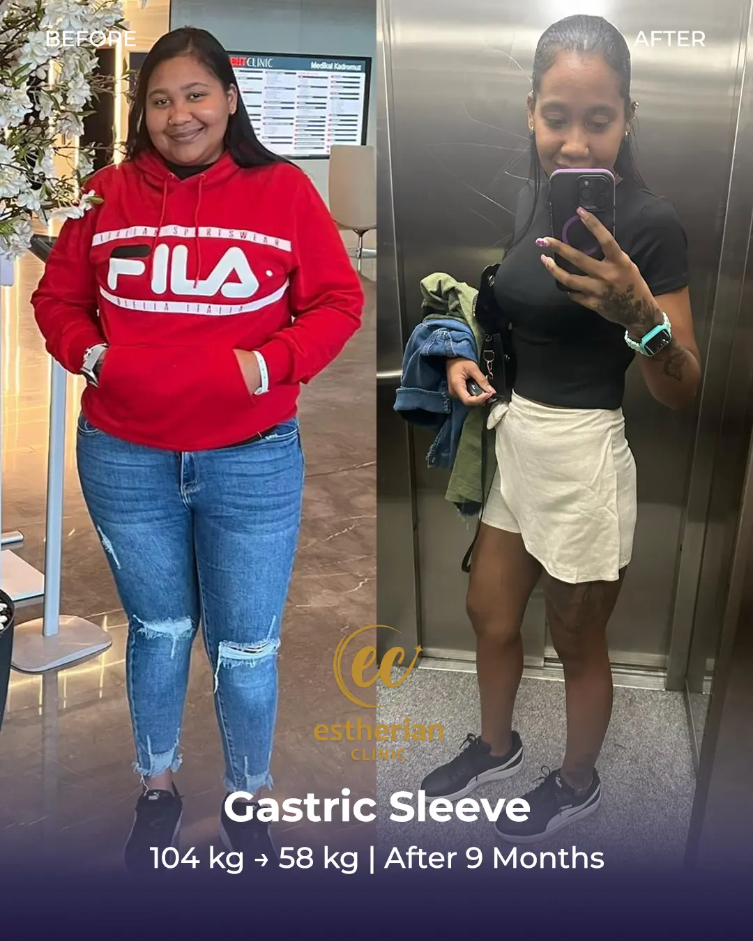 Gastric Sleeve Surgery (Bariatric Surgery) Before-and-after Real Patient Transformation by the Estherian Clinic