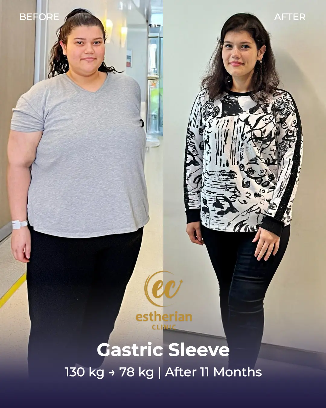 Gastric Sleeve Surgery (Bariatric Surgery) Before-and-after Real Patient Transformation by the Estherian Clinic