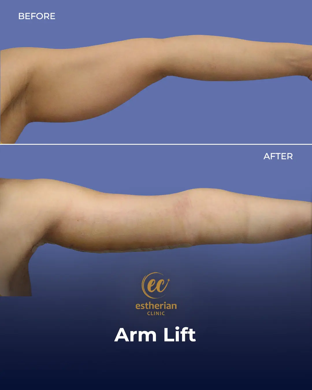 Arm Lift Surgery Before and After Results by the Estherian Clinic
