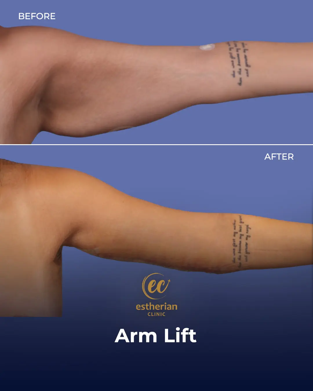 Arm Lift Surgery Before and After Results by the Estherian Clinic