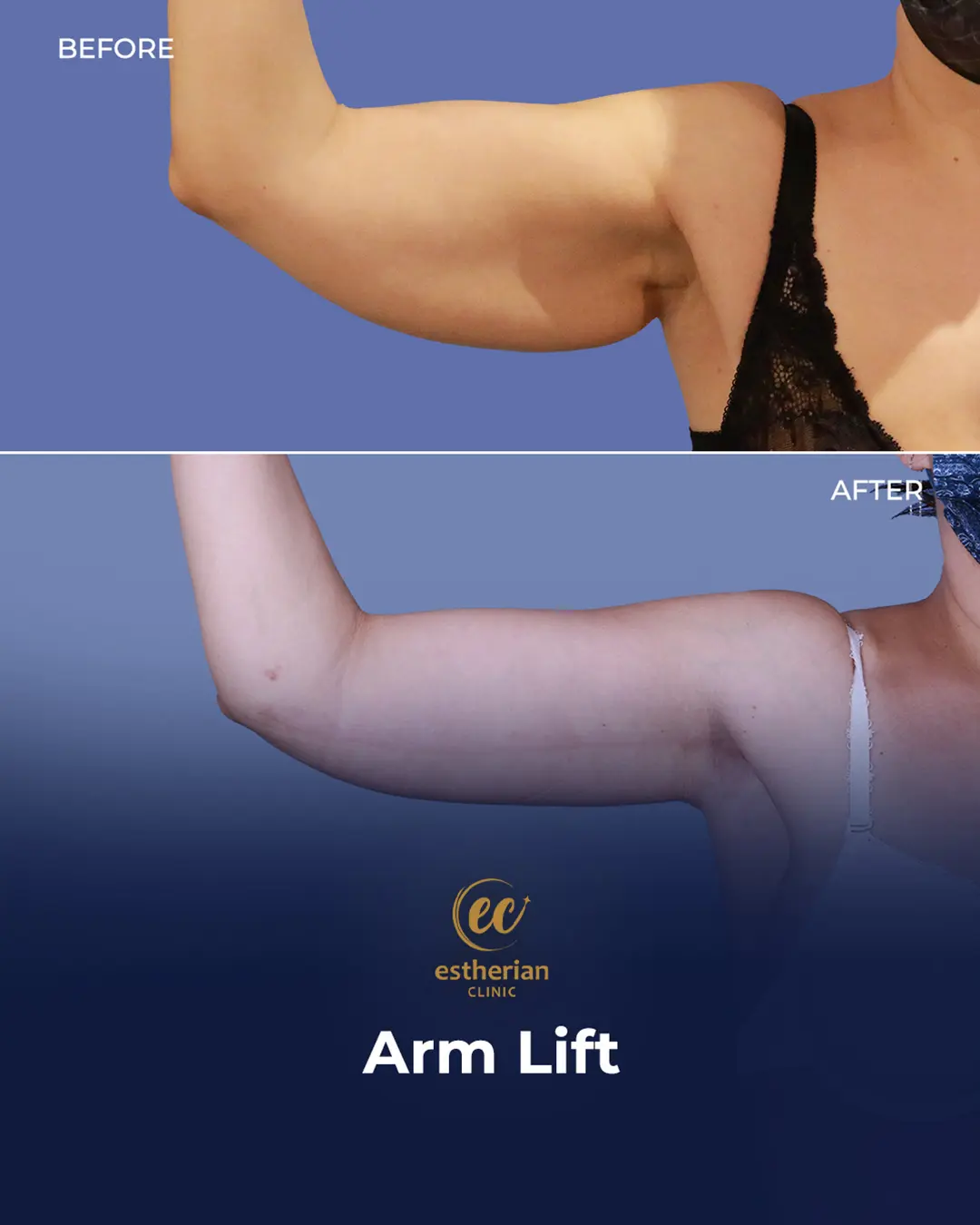 Arm Lift Surgery Before and After Results by the Estherian Clinic