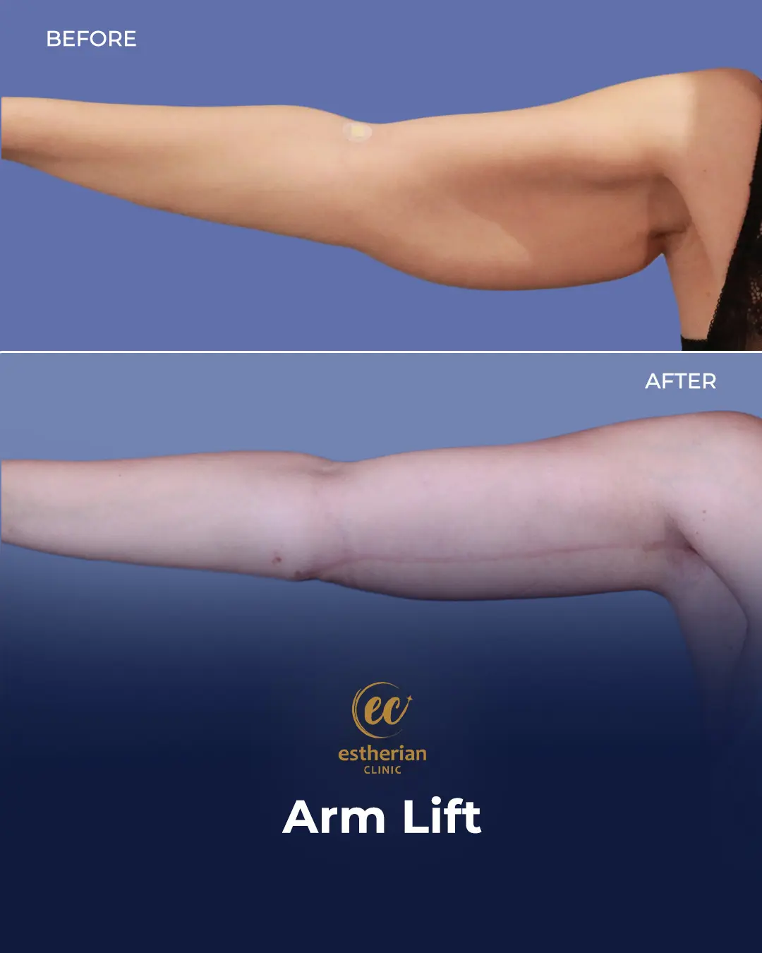Arm Lift Surgery Before and After Results by the Estherian Clinic