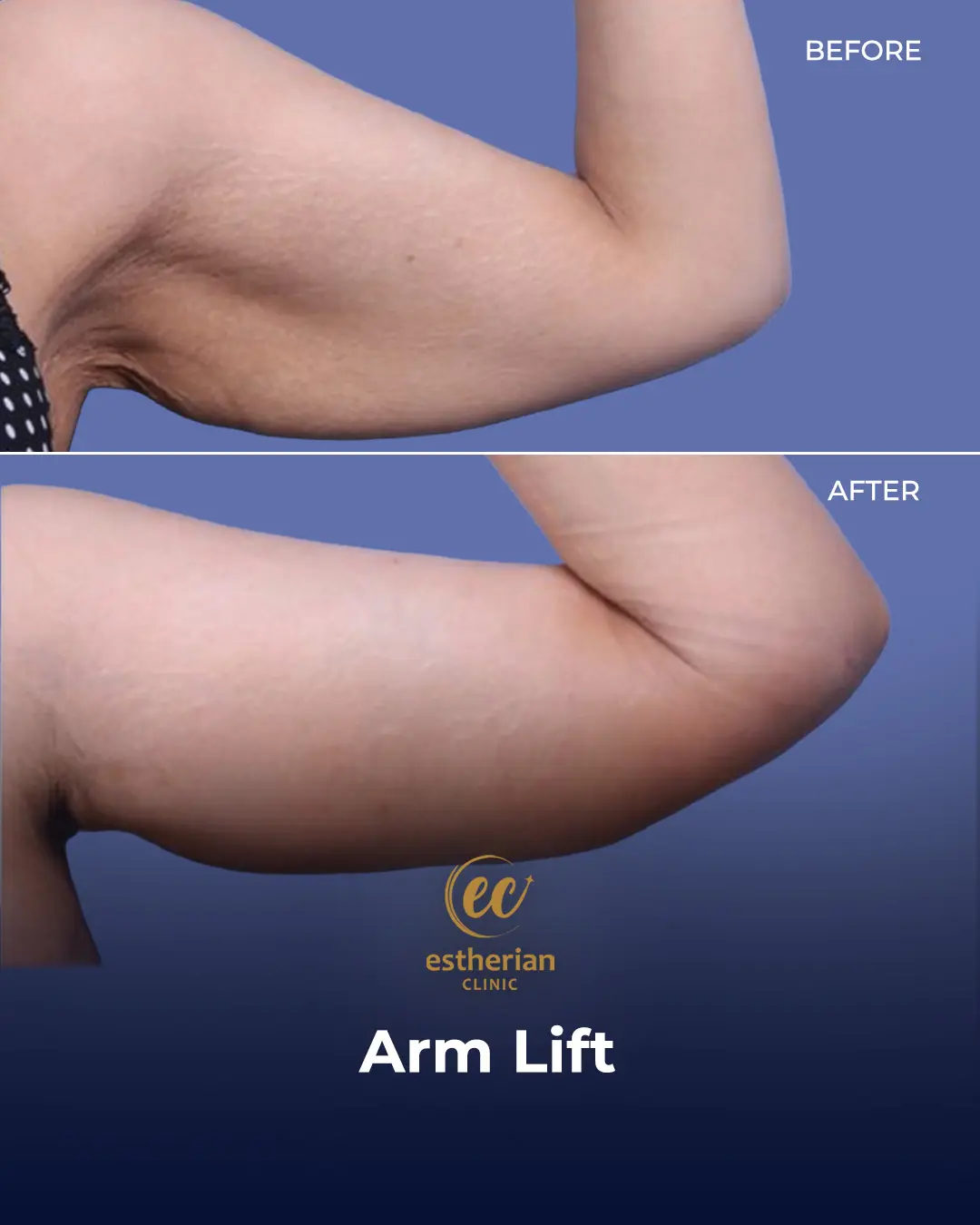 Arm Lift Surgery Before and After Results by the Estherian Clinic