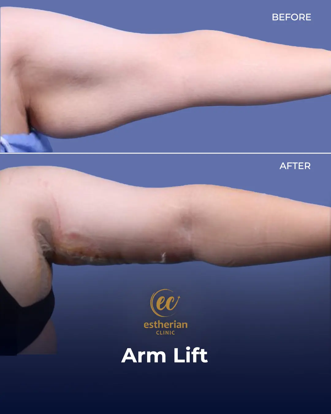 Arm Lift Surgery Before and After Results by the Estherian Clinic