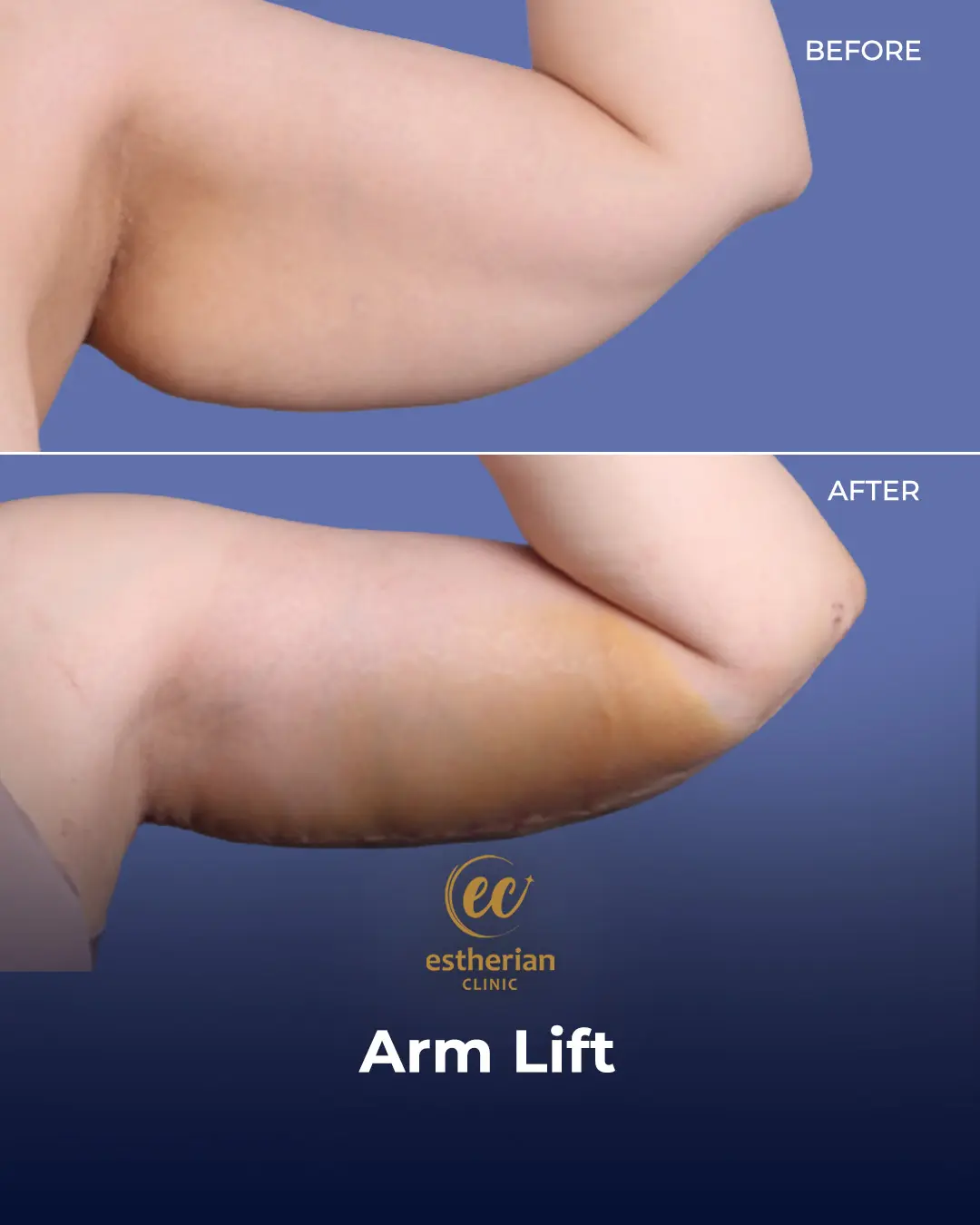 Arm Lift Surgery Before and After Results by the Estherian Clinic