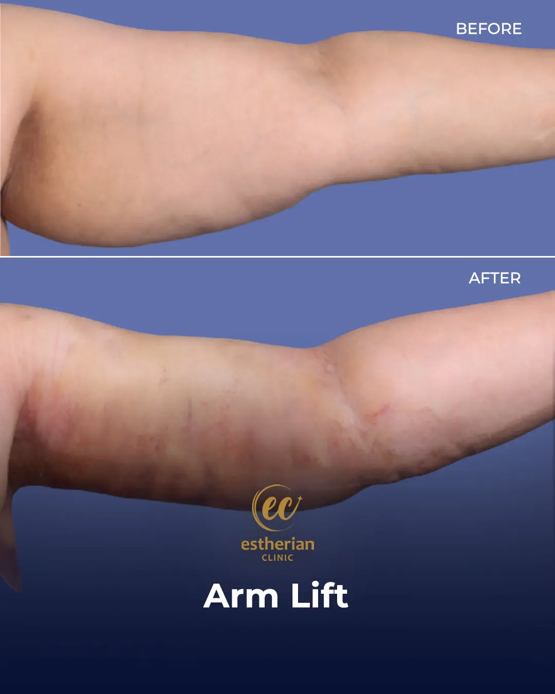Arm Lift Surgery Before and After Results by the Estherian Clinic
