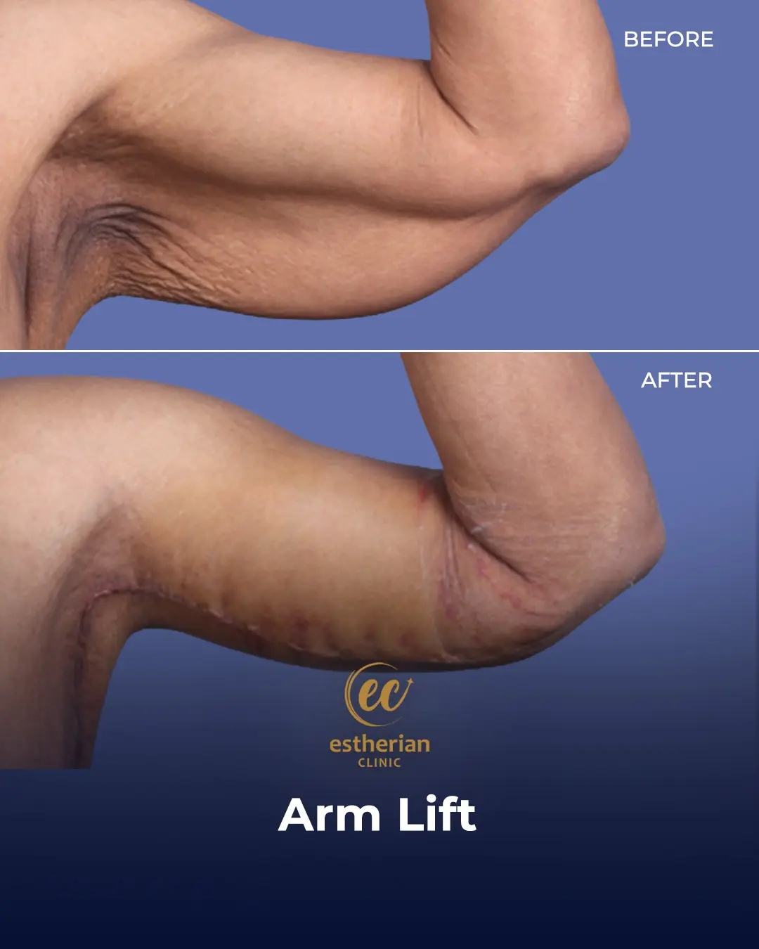 Arm Lift Surgery Before and After Results by the Estherian Clinic