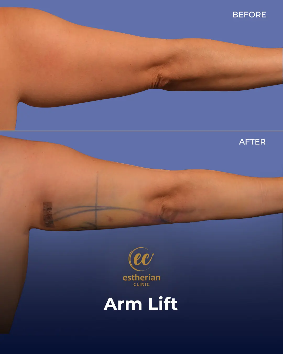 Arm Lift Surgery Before and After Results by the Estherian Clinic