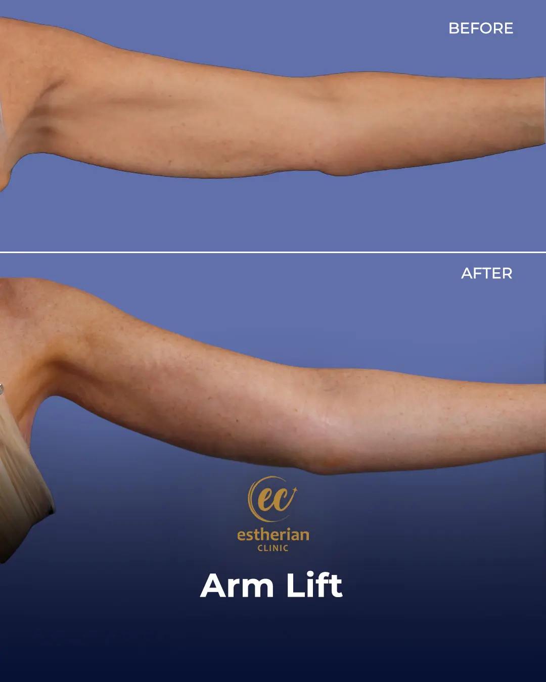 Arm Lift Surgery Before and After Results by the Estherian Clinic
