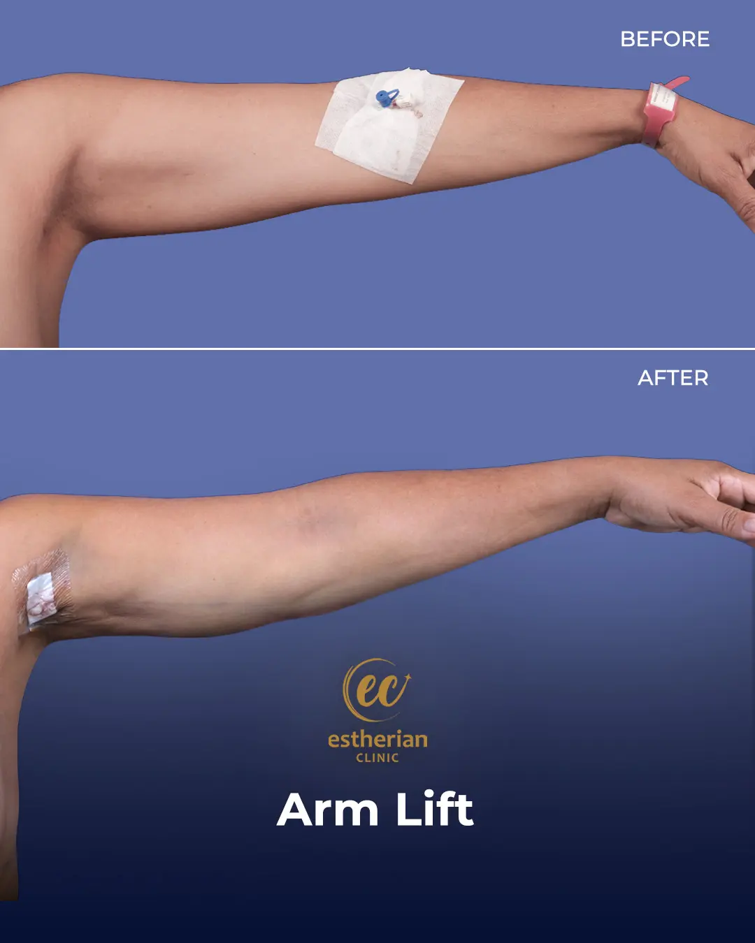 Arm Lift Surgery Before and After Results by the Estherian Clinic
