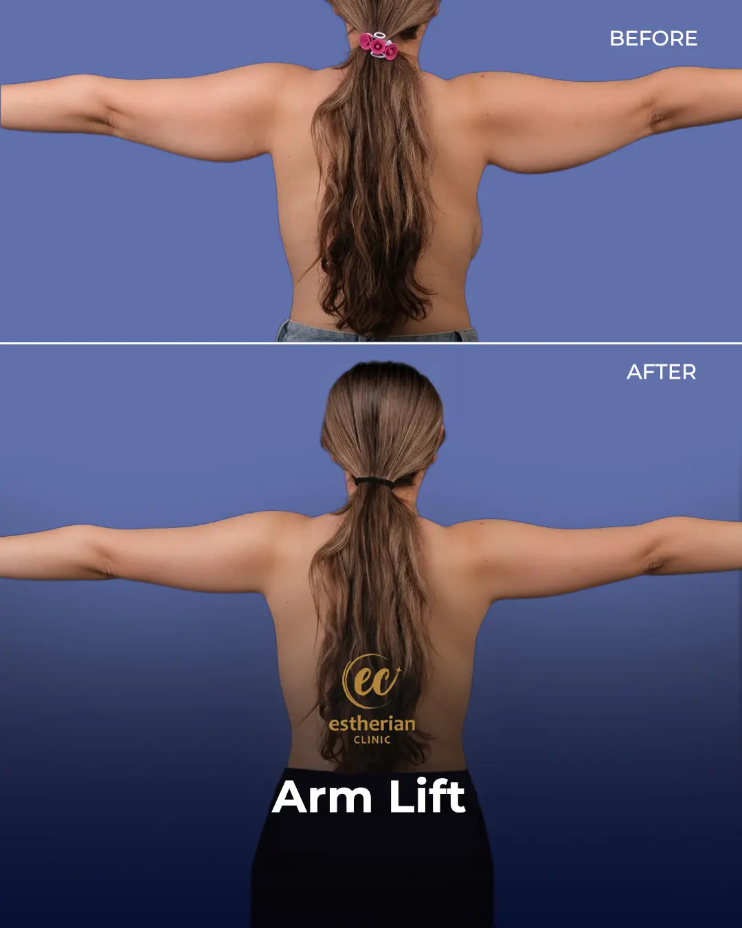 Arm Lift Surgery Before and After Results by the Estherian Clinic