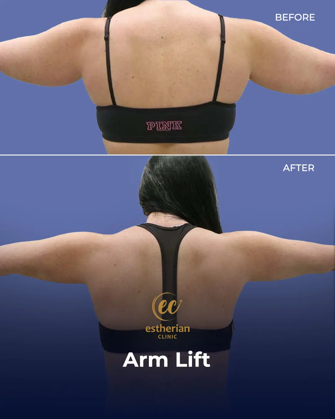 Arm Lift Surgery Before and After Results by the Estherian Clinic