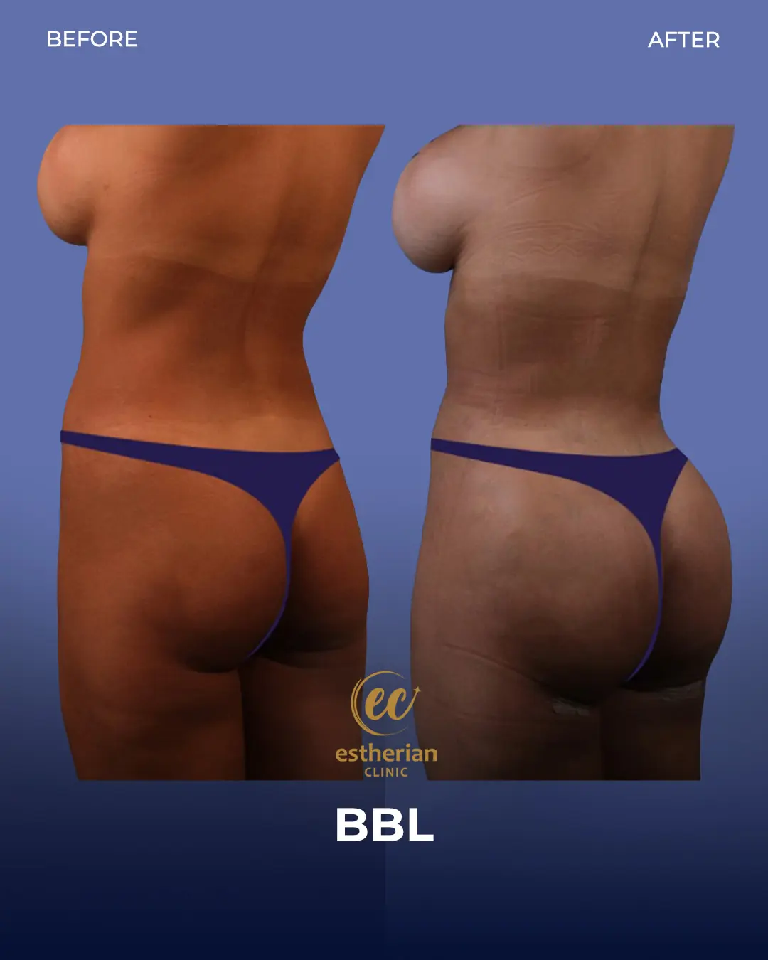BBL - Brazilian Butt Lift Results by the Estherian Clinic
