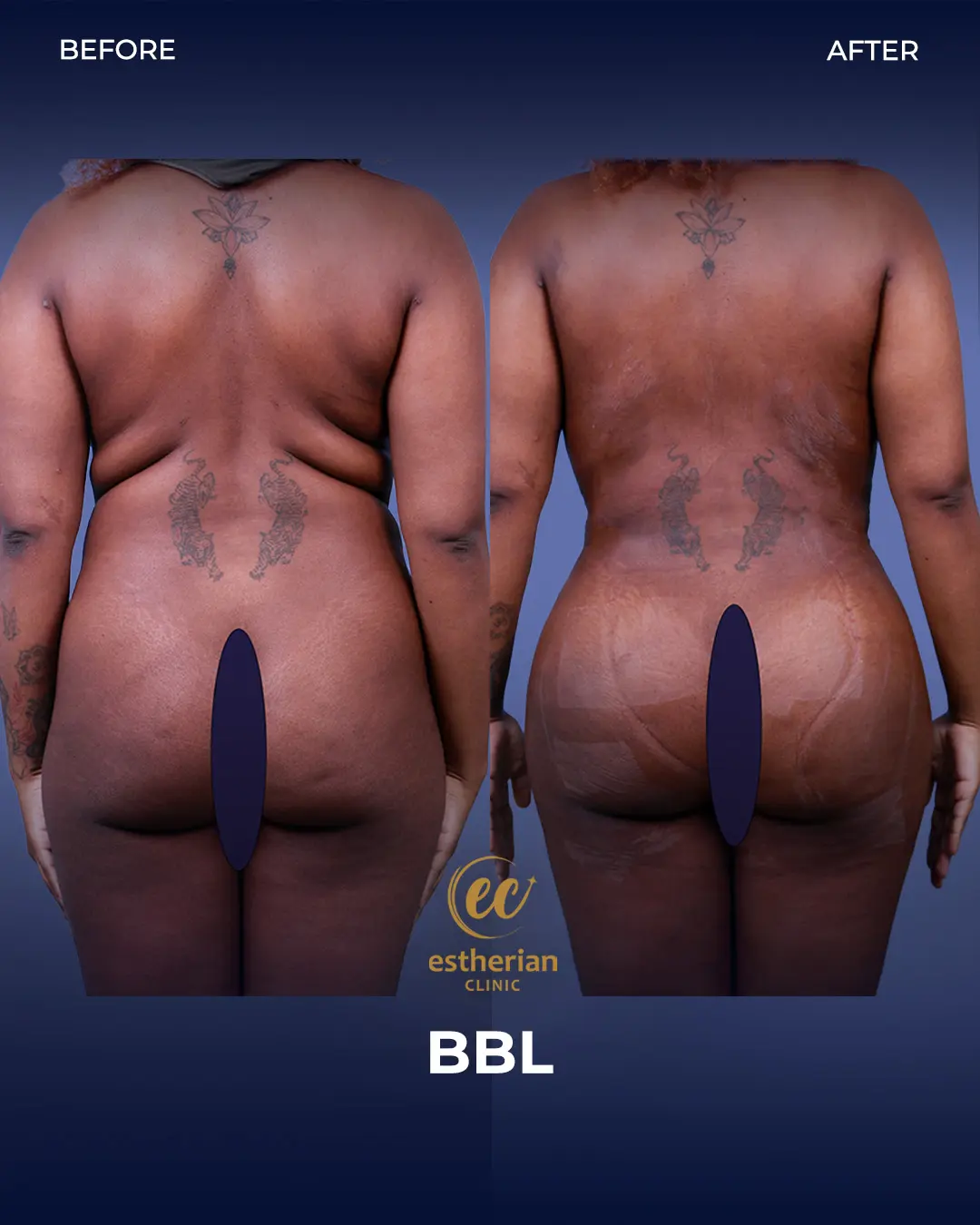 BBL - Brazilian Butt Lift Results by the Estherian Clinic